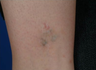 QSR Ruby Laser Tattoo Removal