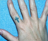 QSR Ruby Laser Tattoo Removal