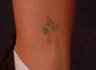QSR Ruby Laser Tattoo Removal