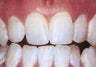 Teeth Whitening (Microabrasion)