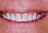 Kor Deep Bleaching Tooth Whitening System