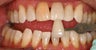 Deep bleaching