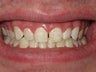 ICON- White Spot Treatment