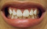 Zoom Teeth Whitening Before and After Photos
