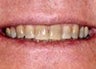Kor Deep Bleaching Tooth Whitening System