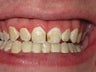 ICON- White Spot Treatment