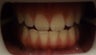 Zoom Teeth Whitening Before and After Photos