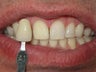 Whitening bleach trays