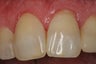 Internal Bleaching of Non-Vital Tooth