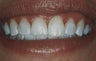 Teeth Whitening