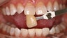 Teeth Whitening