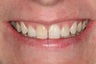 Whitening a single anterior tooth