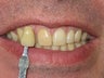 Whitening bleach trays