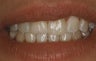 Teeth Whitening