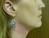Thermage Treatment