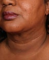 Neck liposuction with thermage