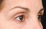Eyes by Thermage