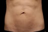 Body contouring
