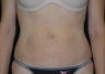 Body contouring
