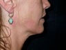 Thermage Treatment