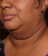 Neck liposuction with thermage