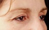 Eyes by Thermage