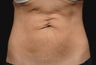 Body contouring