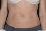Body contouring