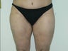 Inner thigh lift