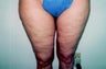 Medial Thigh Lift