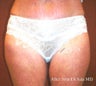 Inner Thigh Lift