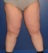 Thigh Lift (Thighplasty)