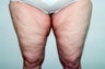 Medial Thigh Lift