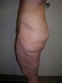 Thigh Lift