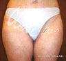 Inner Thigh Lift