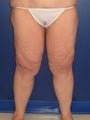 Thigh Lift (Thighplasty)