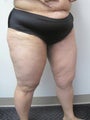 Inner Thigh Lift
