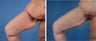 Thighplasty