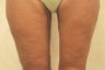 Medial (Inner) Thigh Lift