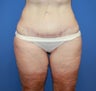 Inner thigh lift