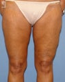 Thigh Lift