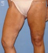 Thigh Lift
