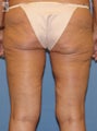 Thigh Lift
