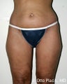 Thigh and Buttock Lift