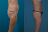 Thigh Lift