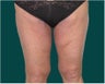 Thigh lift