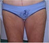 Thigh lift