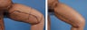 Thighplasty