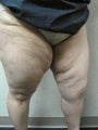 Inner Thigh Lift