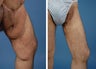 Thighplasty